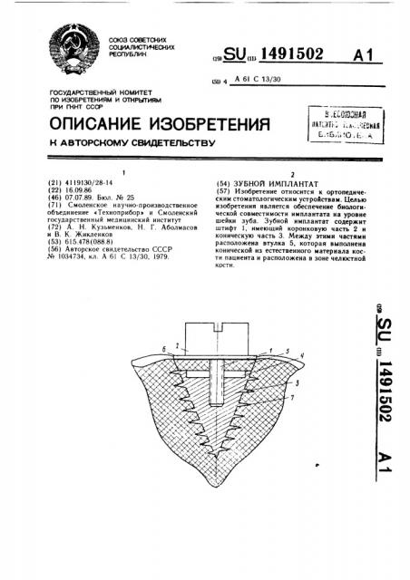 Зубной имплантат (патент 1491502)