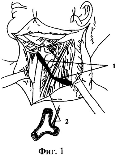 Способ профилактики лимфореи при травматических операциях в надключичной области слева (патент 2328985)