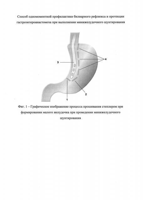 Способ одномоментной профилактики билиарного рефлюкса и протекции гастроэнтероанастомоза при выполнении минижелудочного шунтирования (патент 2629045)