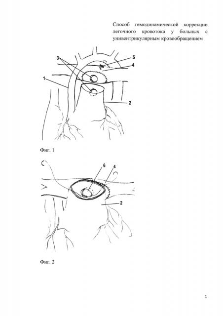 Способ гемодинамической коррекции легочного кровотока у больных с унивентрикулярным кровообращением (патент 2601107)