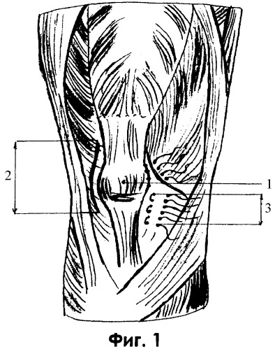 Способ теномиопластической фиксации надколенника с помощью артроскопической техники (патент 2368343)