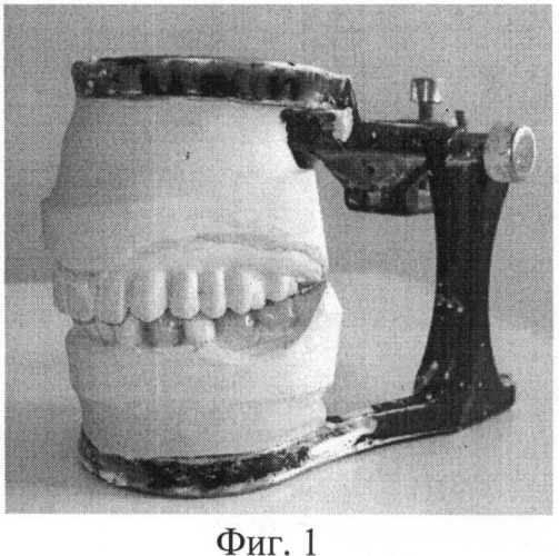 Способ изготовления иммедиат-протеза для лиц с ограниченной мобильностью (патент 2486877)