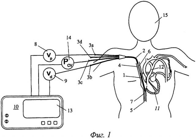 Центральный венозный сенсорный узел для измерения физиологических данных для определения минутного сердечного выброса и способ определения минутного сердечного выброса (патент 2488348)