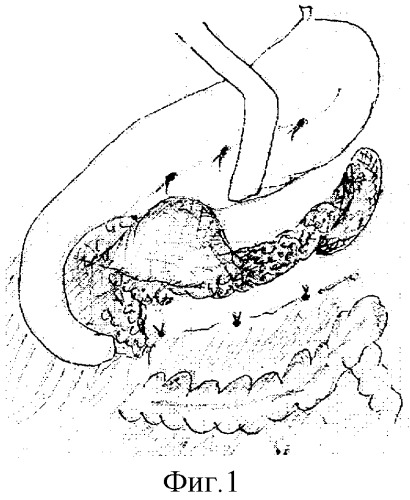 Способ лечения хронических ложных кист головки поджелудочной железы, сообщающихся с главным панкреатическим протоком (патент 2277870)