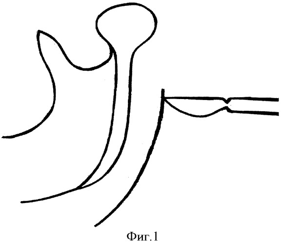 Способ оперативного лечения абсцессов и флегмон крыловидно-нижнечелюстного пространства (патент 2337638)