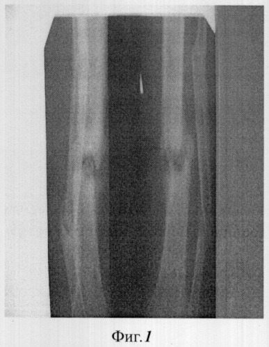 Способ лечения ложных суставов трубчатых костей с рубцово-измененными мягкими тканями (патент 2309690)