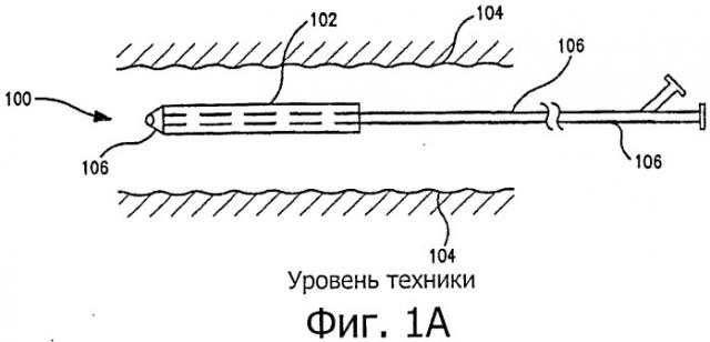 Средство фиксации медицинского устройства, пригодное для стентов, расширяемых с помощью баллона (патент 2512816)