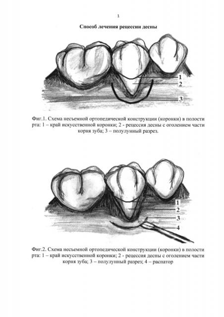 Способ лечения рецессии десны (патент 2649138)