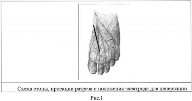 Хирургический способ лечения метатарзалгии (патент 2558461)