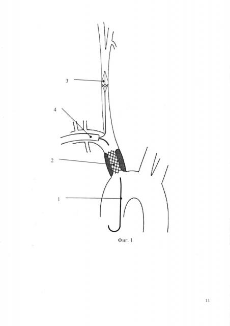 Способ защиты артерий головного мозга от эмболии при ангиопластике и стентировании брахиоцефального ствола (патент 2627352)