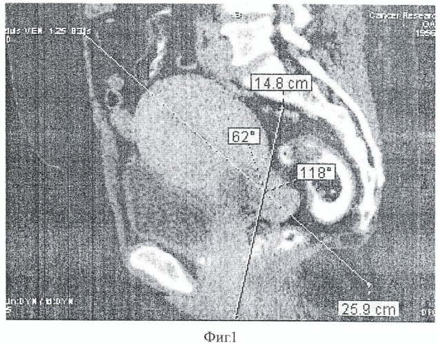 Способ дифференциальной диагностики гигантских неорганных забрюшинных опухолей и опухолей яичников и матки (патент 2408272)
