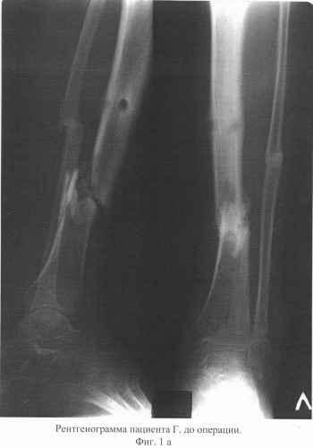 Способ лечения несросшихся переломов и ложных суставов костей голени, осложненных хроническим травматическим остеомиелитом (патент 2311144)