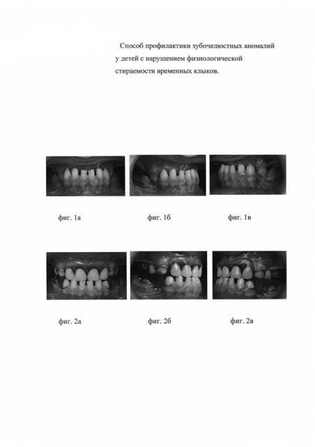 Способ лечения зубочелюстных аномалий у детей с нарушением физиологической стираемости временных клыков (патент 2593233)