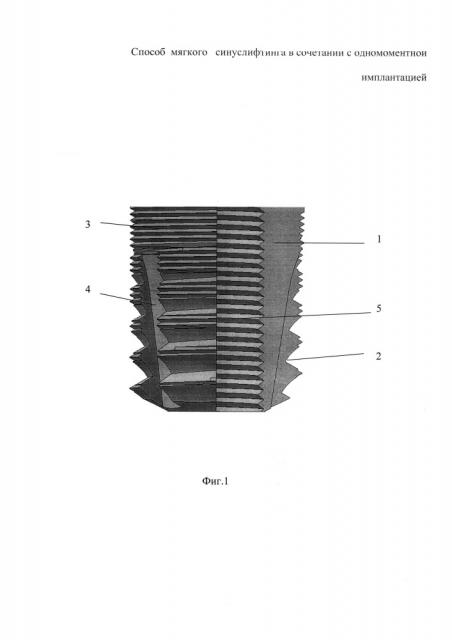 Способ мягкого синуслифтинга в сочетании с одномоментной имплантацией (патент 2651085)