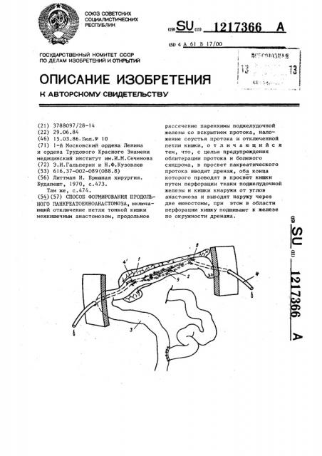 Способ формирования продольного панкреатоеюноанастомоза (патент 1217366)