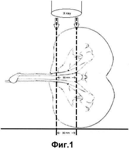 Способ проведения рентгенконтрастной уретрографии в боковой проекции (патент 2592683)