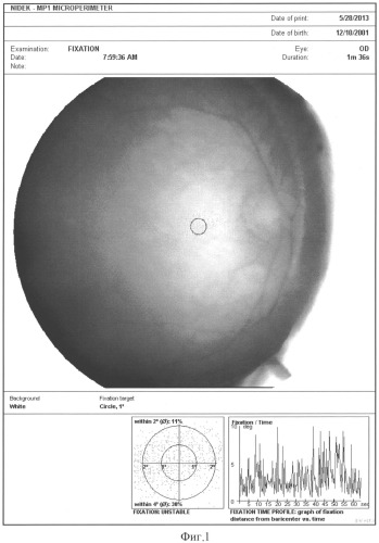 Способ оценки эффективности лечения оптического нистагма с использованием микропериметрии (патент 2535511)