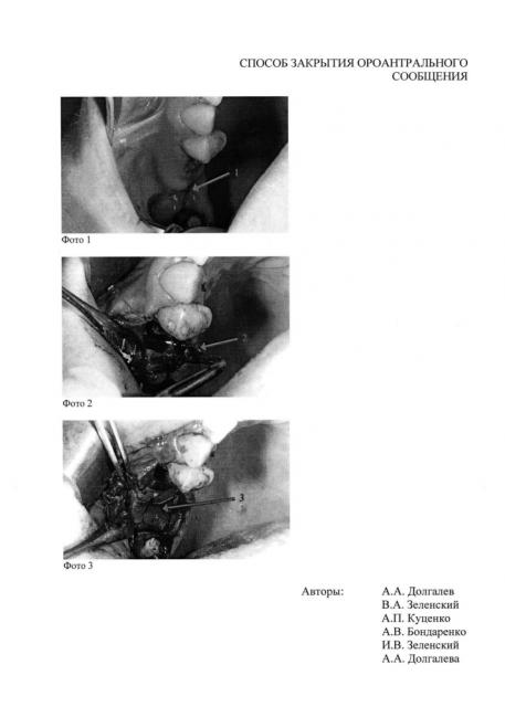 Способ закрытия ороантрального сообщения (патент 2664194)