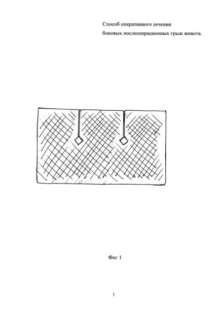 Способ оперативного лечения боковых послеоперационных грыж живота (патент 2626596)
