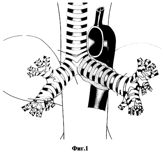 Способ реконструкции бифуркации трахеи после циркулярной резекции карины и левого главного бронха (патент 2270616)