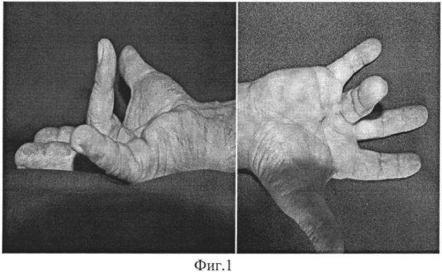 Способ безоперационного лечения контрактуры дюпюитрена iii-iv степени тяжести (патент 2540919)