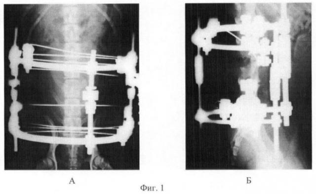 Способ получения модели заднего спондилодеза (патент 2452998)