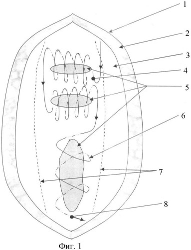 Способ устранения послеоперационных рецидивных многокамерных вентральных грыж брюшной стенки (патент 2408318)