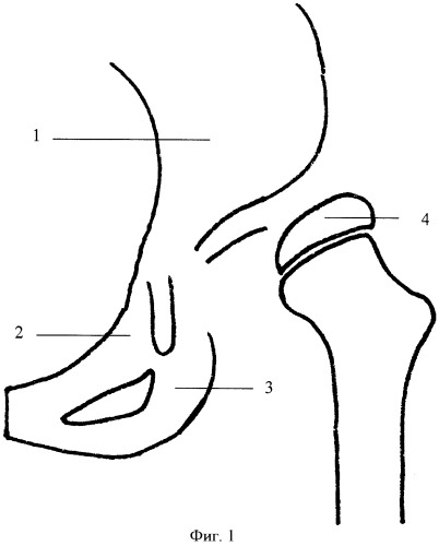 Способ транспозиции вертлужной впадины после тройной остеотомии таза (патент 2414186)