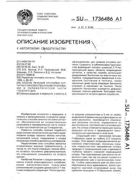 Способ лечения отслойки сетчатки с множественными разрывами в периферической части глазного дна (патент 1736486)