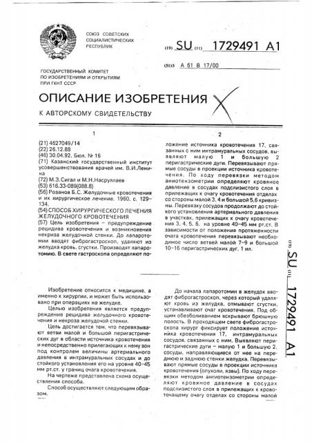 Способ хирургического лечения желудочного кровотечения (патент 1729491)