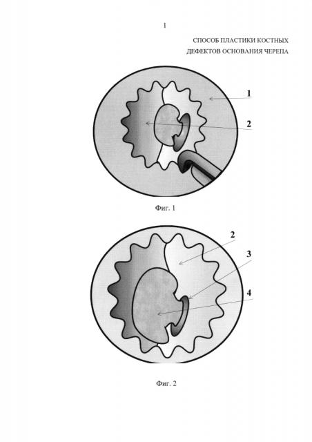 Способ пластики костных дефектов основания черепа (патент 2598457)