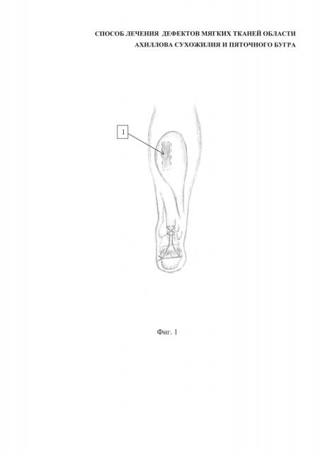 Способ лечения дефектов мягких тканей области ахиллова сухожилия и пяточного бугра (патент 2601859)