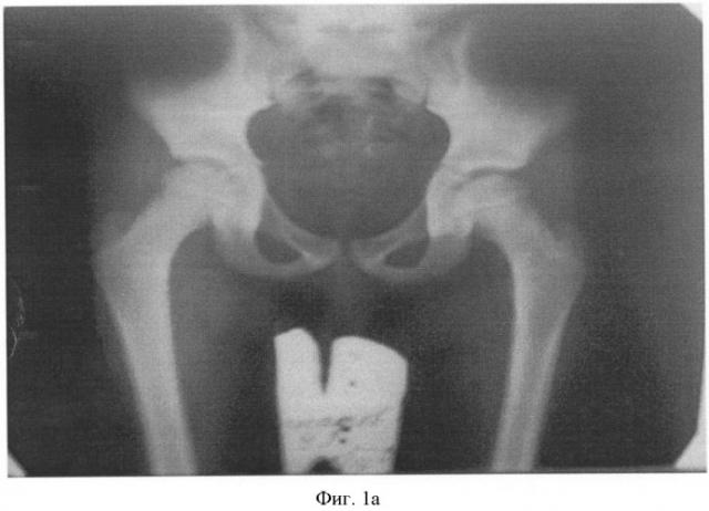 Способ лечения сочетанной деформации таза и позвоночника у детей (патент 2423095)