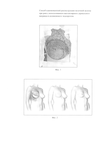 Способ одномоментной реконструкции молочной железы при раке с использованием ацеллюлярного дермального матрикса и силиконового эндопротеза (патент 2584133)