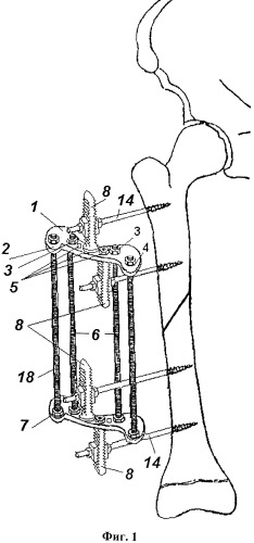 Аппарат для лечения повреждений и заболеваний длинных трубчатых костей у детей (патент 2454963)
