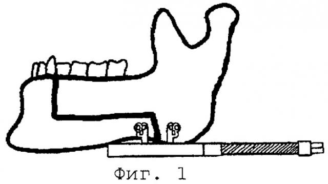 Способ устранения нижней ретрогнатии (патент 2289344)