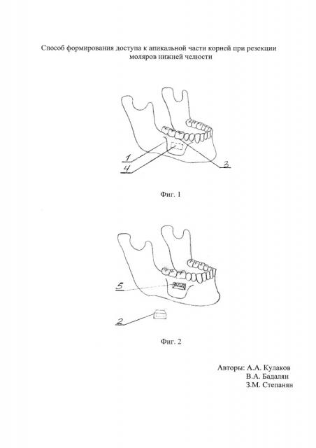 Способ формирования доступа к апикальной части корней при резекции моляров нижней челюсти (патент 2655082)