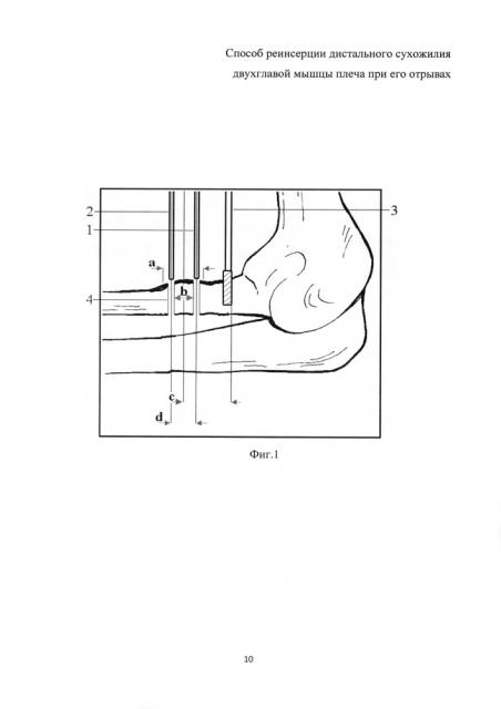 Способ реинсерции дистального сухожилия двуглавой мышцы плеча при его отрывах (патент 2663384)
