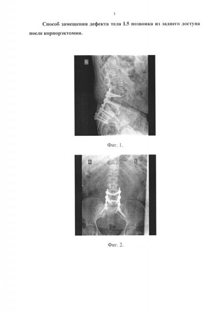 Способ замещения дефекта тела l5 позвонка из заднего оперативного доступа после корпорэктомии (патент 2594445)