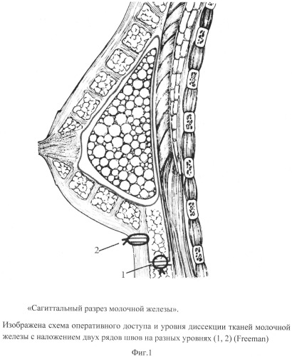 Способ инфрамаммарного доступа при кожесохраняющей мастэктомии с одномоментной реконструкцией силиконовым имплантатом (патент 2545431)