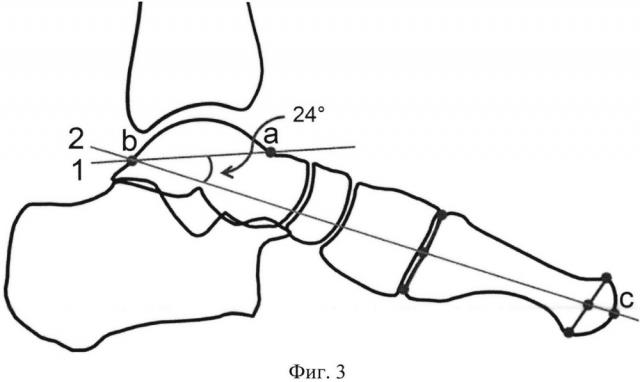 Способ предоперационного планирования хирургической коррекции деформации стопы на уровне среднего отдела (патент 2639430)