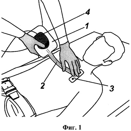 Способ определения места имплантации аппарата для подкожного мониторирования электрокардиограммы (патент 2445917)
