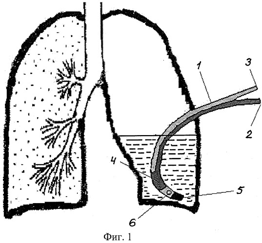 Способ фракционного дренирования плевральной полости и устройство для его осуществления (патент 2402354)