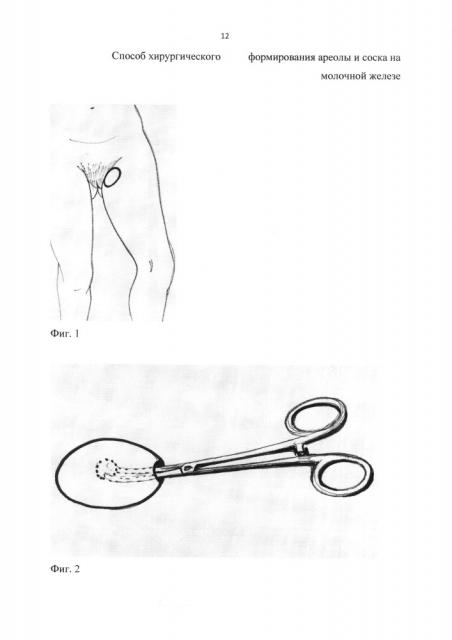 Способ хирургического формирования ареолы и соска на молочной железе (патент 2647154)
