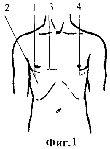 Способ лечения врожденной асимметричной килевидной деформации грудной клетки у детей (патент 2386409)