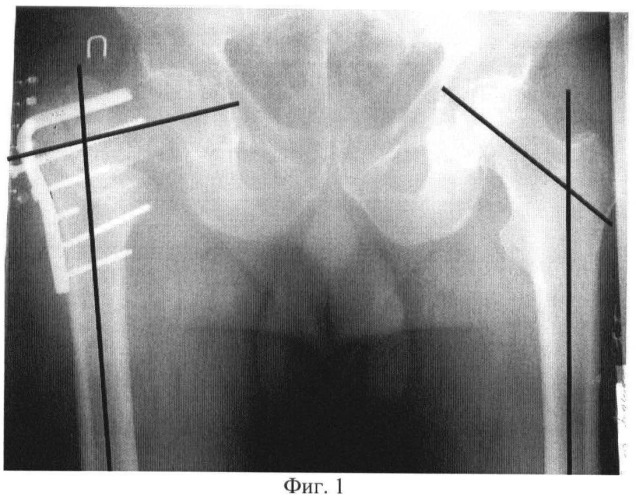 Способ коррекции варусной деформации проксимального отдела бедра (патент 2462205)