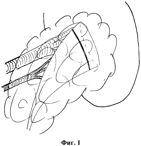 Способ формирования почечной ножки в условиях склерозирующего педункулита при нефрэктомии (патент 2308239)