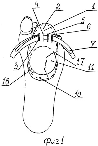 Корректор переднего отдела стопы (патент 2341234)
