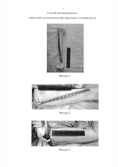 Способ малоинвазивного накостного остеосинтеза при переломах диафиза и хирургической шейки плечевой кости (патент 2594444)