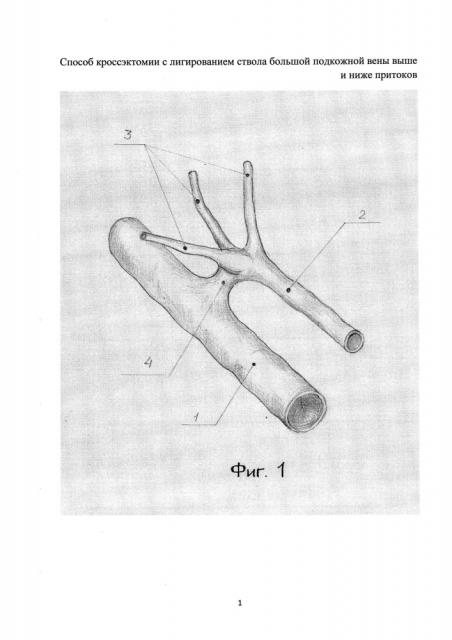 Способ кроссэктомии с лигированием ствола большой подкожной вены выше и ниже притоков (патент 2607919)